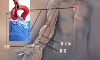冠脈介入手術(shù)術(shù)后注意事項,冠脈介入進修匯報ppt,冠脈介入術(shù)前術(shù)后的注意事項