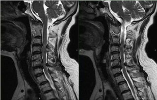 脊椎狹窄術(shù)后注意事項(xiàng),脊椎正骨后的注意事項(xiàng),脊椎復(fù)位后注意事項(xiàng)