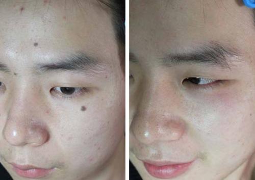 點痣有什么注意事項