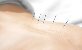 針灸,注意事項(xiàng)