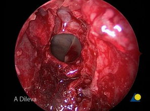 腦垂體,切除,注意事項(xiàng)