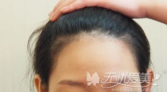 頭發(fā)種植前后注意事項(xiàng)
