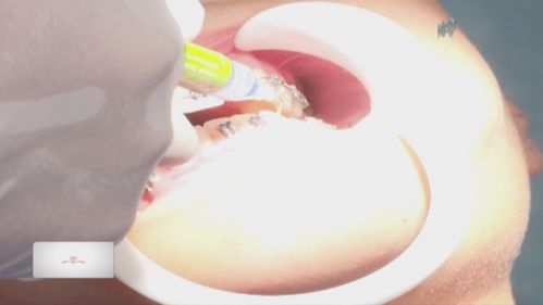 拔牙沒拔牙根注意事項(xiàng)