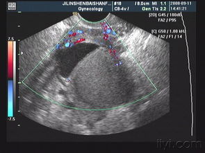 子宮囊性腫塊注意事項
