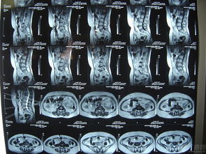 腰椎壓縮性骨折后飲食注意事項(xiàng)