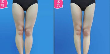 大腿吸脂后應(yīng)注意事項