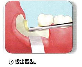 智齒拔牙縫合注意事項