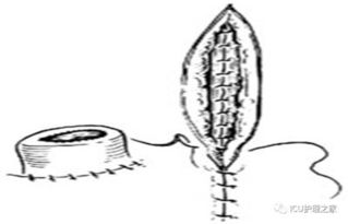 回腸造瘺術(shù)后注意事項