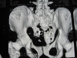 骶尾椎骨折注意事項