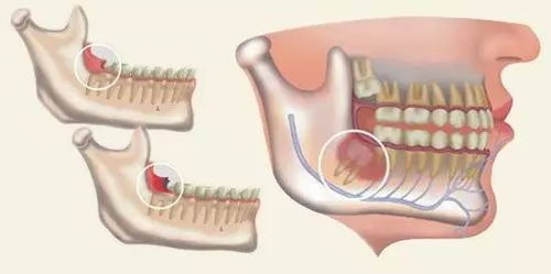 智齒切肉注意事項(xiàng)