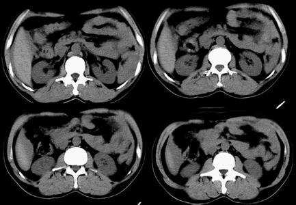搬運(yùn)肝脾破裂注意事項
