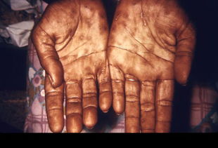 紅霉素治療梅毒的注意事項