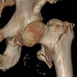 骨折兩周后注意事項(xiàng)