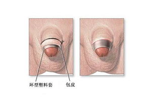 做完包皮環(huán)切注意事項