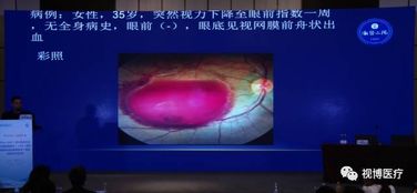 視網(wǎng)膜色變注意事項
