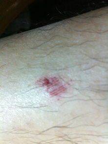 注意事項(xiàng),抓傷