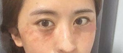 眼袋,割下,注意事項(xiàng)