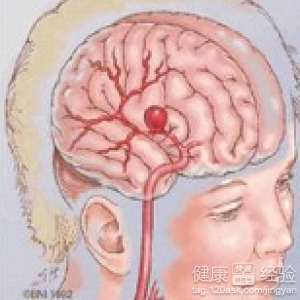 腦動脈瘤夾閉術(shù)后10年,腦動脈瘤夾閉術(shù)后三個月,腦動脈瘤術(shù)后飲食注意事項