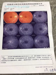 眼科造影注意事項(xiàng)