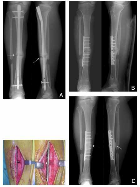 脛骨骨折手術(shù)后注意事項(xiàng),脛骨截骨術(shù)后注意事項(xiàng),脛骨取鋼板后注意事項(xiàng)