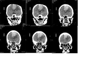 腦膜瘤術(shù)后飲食注意事項