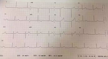 測量動態(tài)心電圖注意事項(xiàng),做心電圖注意事項(xiàng),心電圖的使用方法及注意事項(xiàng)