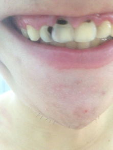 撥門牙要注意事項(xiàng)