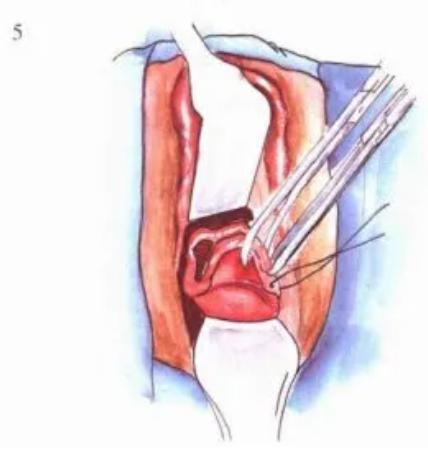 宮頸口裂傷后注意事項(xiàng)