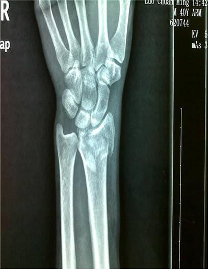 橈骨遠(yuǎn)端骨折注意事項(xiàng)