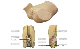 穿刺陰道注意事項