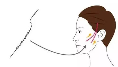 線雕眼袋注意事項(xiàng)