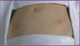 五歲男孩闌尾炎手術(shù)后注意事項(xiàng)