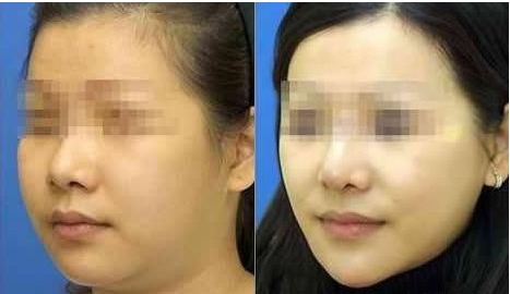 面部抽脂前后要注意事項