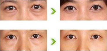 眼袋手術(shù)術(shù)后注意事項