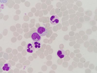 懸浮紅細胞輸注的注意事項