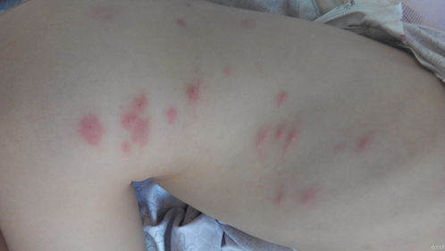 螨蟲皮炎注意事項