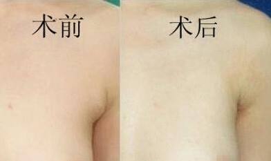副乳切除術(shù)后注意事項(xiàng),切副乳術(shù)后注意事項(xiàng),吸脂術(shù)后注意事項(xiàng)