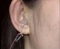 電針炙后注意事項