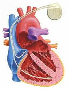 永久起搏器術(shù)后注意事項(xiàng),膠囊起搏器術(shù)后注意事項(xiàng),安裝起搏器術(shù)后注意事項(xiàng)