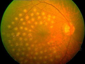 黃斑,注意事項(xiàng),雙眼