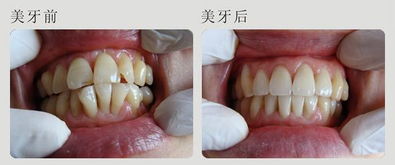 注意事項,剛修完牙