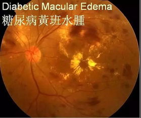 有什么,黃斑,水腫,注意事項(xiàng)