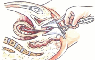 注意事項,取環(huán),丅型環(huán)