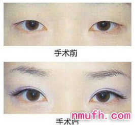 雙眼皮,武漢,術(shù)后,注意事項(xiàng)
