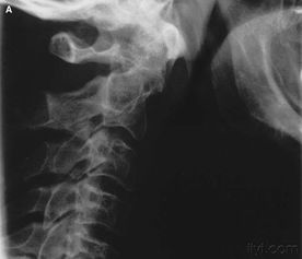 脖子骨折睡覺注意事項