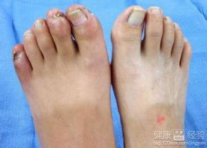 血栓性脈管炎注意事項(xiàng)