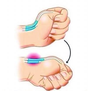 寶寶腱鞘炎手術(shù)后注意事項(xiàng)