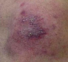 皮肌炎需要注意事項(xiàng)