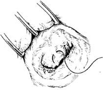 術(shù)后,置換,注意事項,二尖瓣