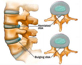 腰椎間盤(pán)突出癥患者注意事項(xiàng)